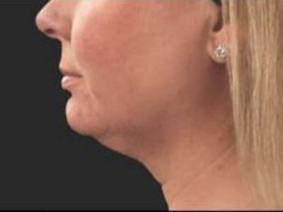 Double chin of a patient in Perth before treatment.