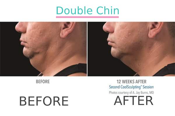 Double chin treatment to a patient before and after.