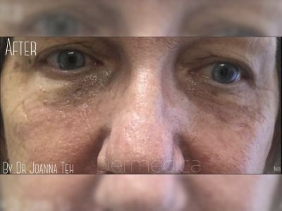 Nonsurgical eye bags treatment of a patient in Perth after.