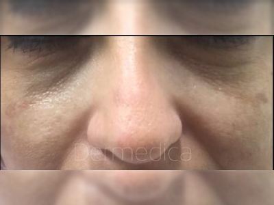 Nonsurgical eye bags treatment of a patient in Perth before.
