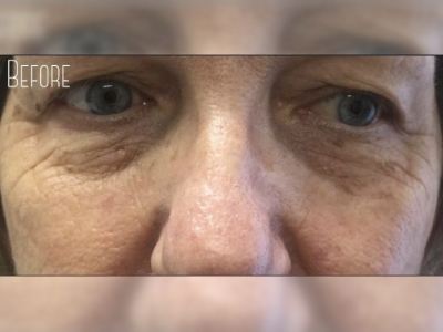 Nonsurgical eye bags treatment of a patient in Perth before.