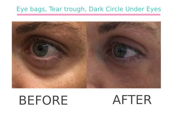 Eye bags, Tear trough, Dark Circle Under Eyes treatment to a patient before and after.