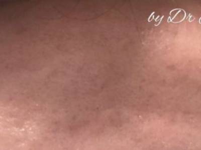 Forehead scars after fractional resurfacing treatment in perth.
