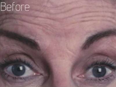 forehead lines of a adult woman before antiwrinkle injection