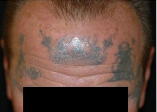 forehead tattoo before