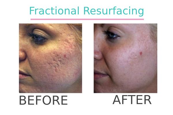 Fractional Resurfacing treatment to a patient before and after.