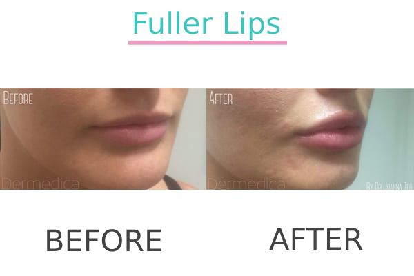 Effective lip filler treatment result of a patient.