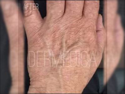 Nonsurgical hand rejuvenation treatment of a patient in Perth after.