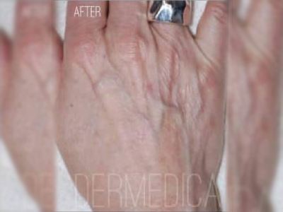 Nonsurgical hand rejuvenation treatment of a patient in Perth after.