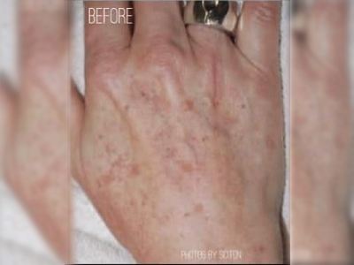 Nonsurgical hand rejuvenation treatment of a patient in Perth before.