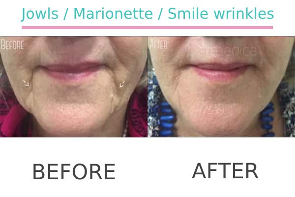 Jowls, Marionette and Smile wrinkles treatment to a patient in Perth before and after.