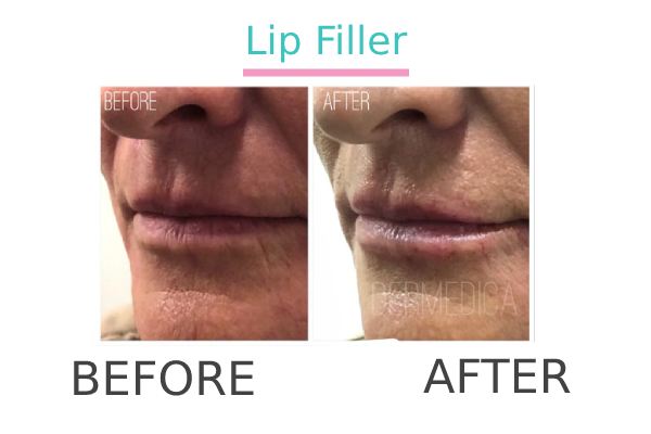 Lip filler treatment to a patient before and after.