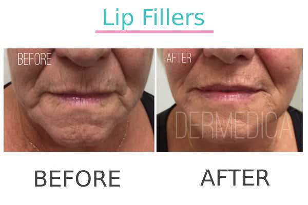 Effective lip filler treatment result of a patient before and after.