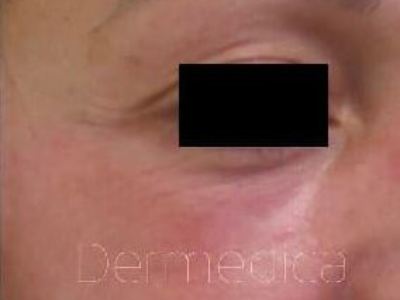 Nonsurgical melasma treatment of a patient in Perth after.