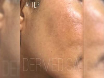 Nonsurgical melasma treatment of a patient in Perth after.