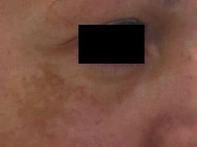 Nonsurgical melasma treatment of a patient in Perth before.