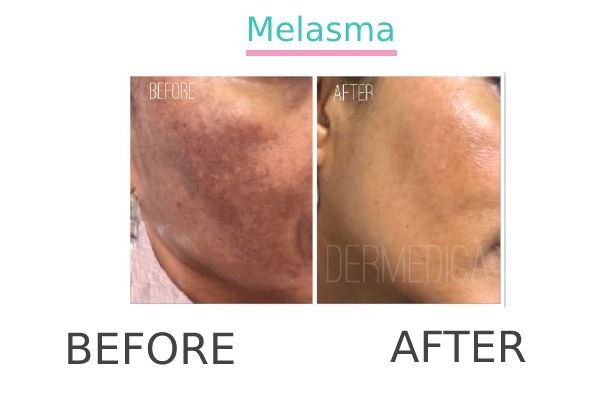 Melasma treatment to a patient in Perth before and after.