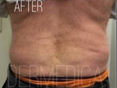 Coolsculping treatment in waist after.