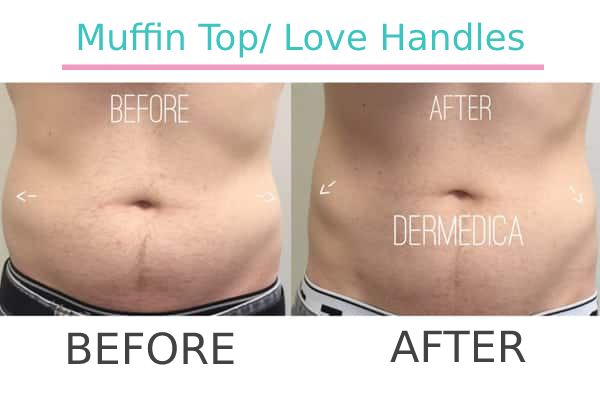 Coolsculpting muffin of a patient in Perth before and after.