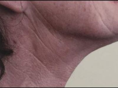 Nonsurgical neck treatment of a patient in Perth after.