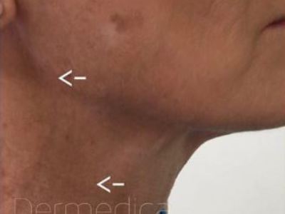Nonsurgical neck treatment of a patient in Perth after.