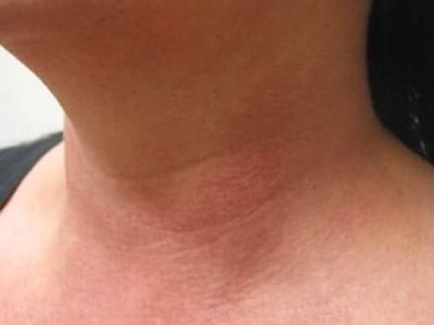 Nonsurgical neck treatment of a patient in Perth before.