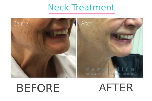 Neck treatment to a patient in Perth before and after.
