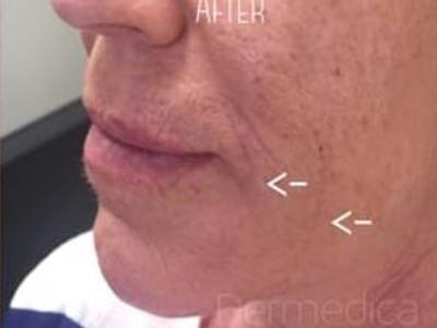 Nonsurgical dermal filler of an adult man in Perth after.