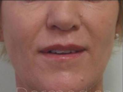 non surgical facelift of a adult woman after