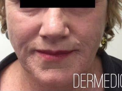 non surgical facelift of a adult woman after in perth