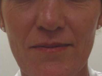 non surgical facelift of a adult woman before