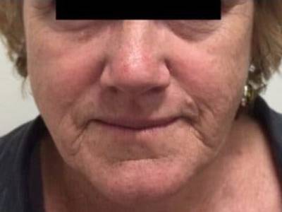 non surgical facelift of a adult woman before in perth