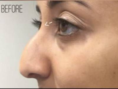 Non surgical nose filler treatment in perth before.