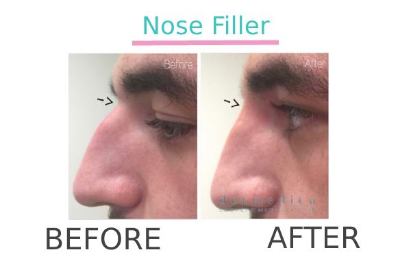 Nose Filler treatment to a patient before and after.