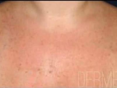 Nonsurgical pigmentation treatment of a patient in Perth after.