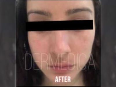 Nonsurgical pigmentation treatment of a patient in Perth after.