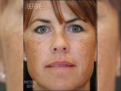 Nonsurgical pigmentation treatment of a patient in Perth before.