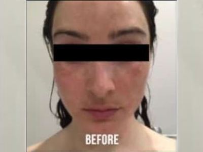 Nonsurgical pigmentation treatment of a patient in Perth before.