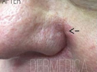 Nonsurgical rosacea treatment of a patient in Perth after.