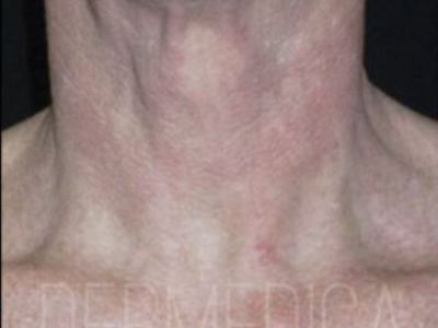 Nonsurgical rosacea treatment of a patient in Perth after.