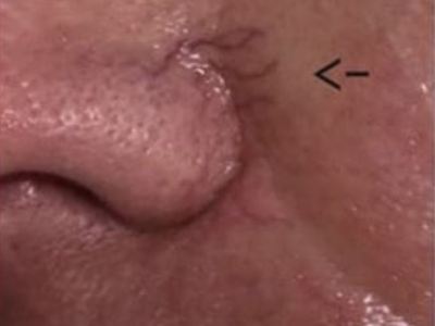Nonsurgical rosacea treatment of a patient in Perth before.