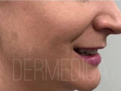 Skin needling treatment in Perth after.