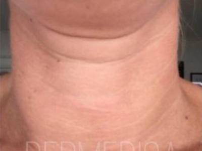 Skin needling treatment in neck in Perth after.