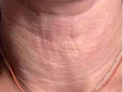 Skin needling treatment in neck in Perth before.