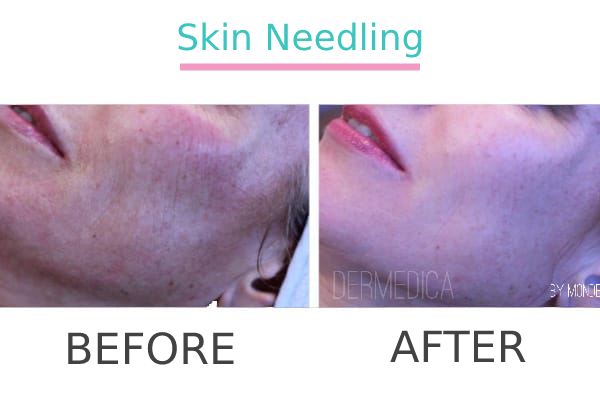 Skin needling treatment to a patient before and after.