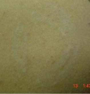 skin tattoo removal  after