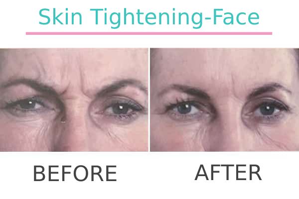 Exilis Skin Tightening Face treatment result of a patient before and after.