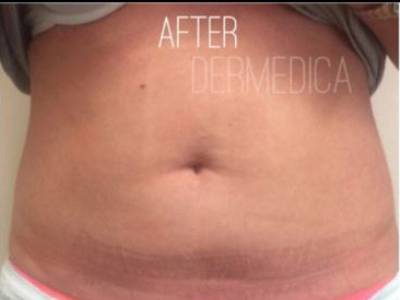 Abdomen fat removal to a patient with Coolsculpting for Abdomen treatment after.