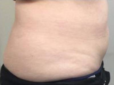 Close up stomach fat of a patient after coolsculpting.