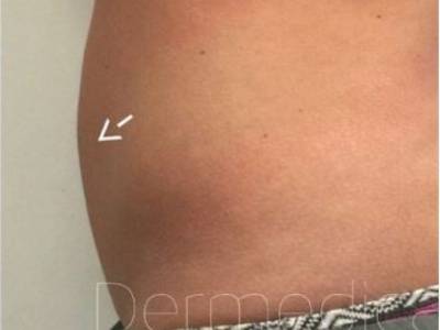 Abdomen fat of a patient with Coolsculpting after.